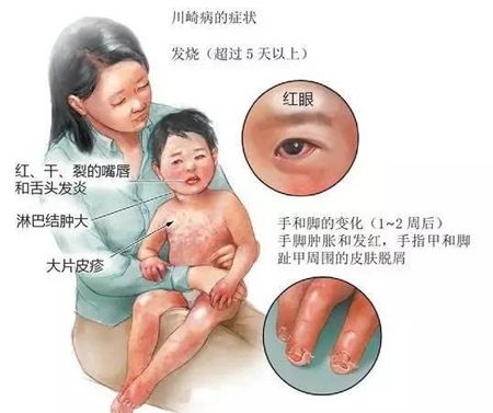 小儿轮状病毒症状图片